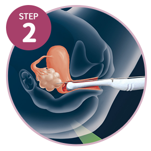 試管嬰兒步驟2-超音波取卵