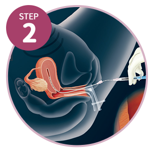 人工受孕步驟2-人工授精