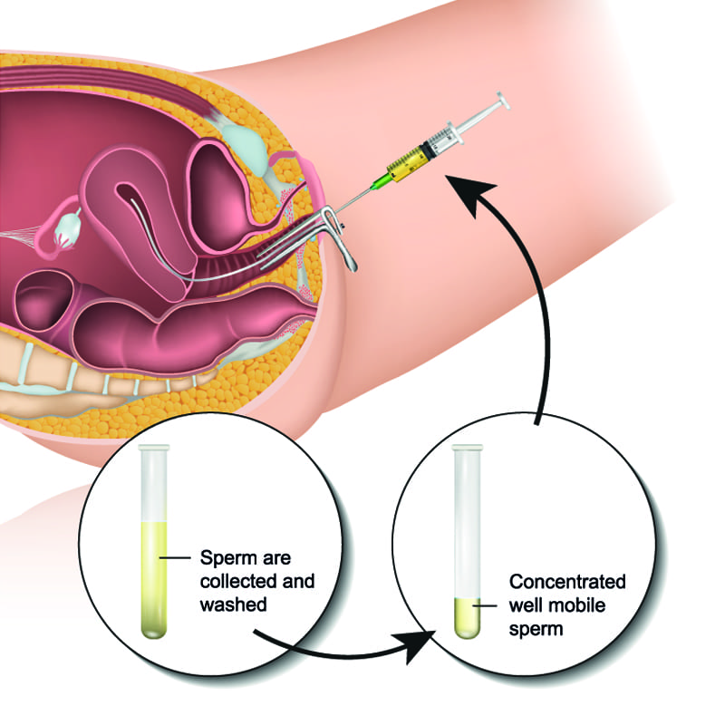 人工受孕（Intrauterine insemination，IUI）